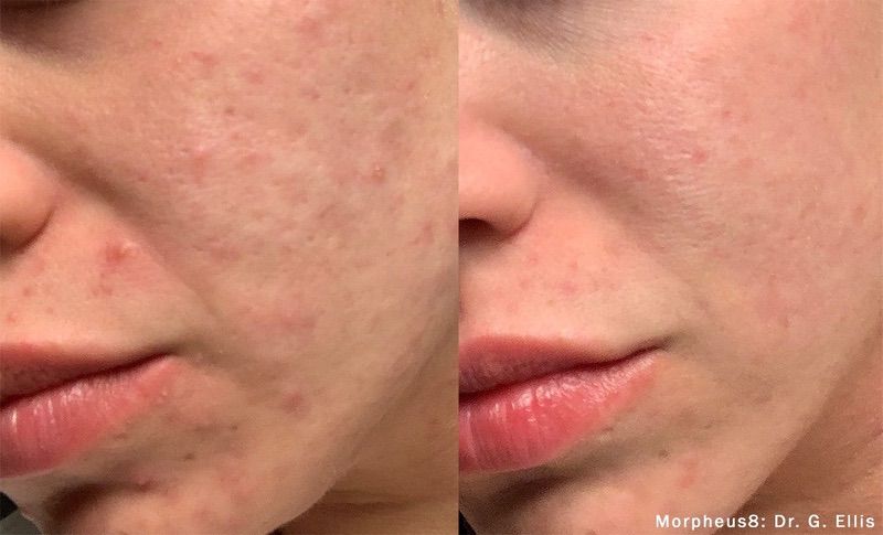 acne scar treatment before and after morpheus8